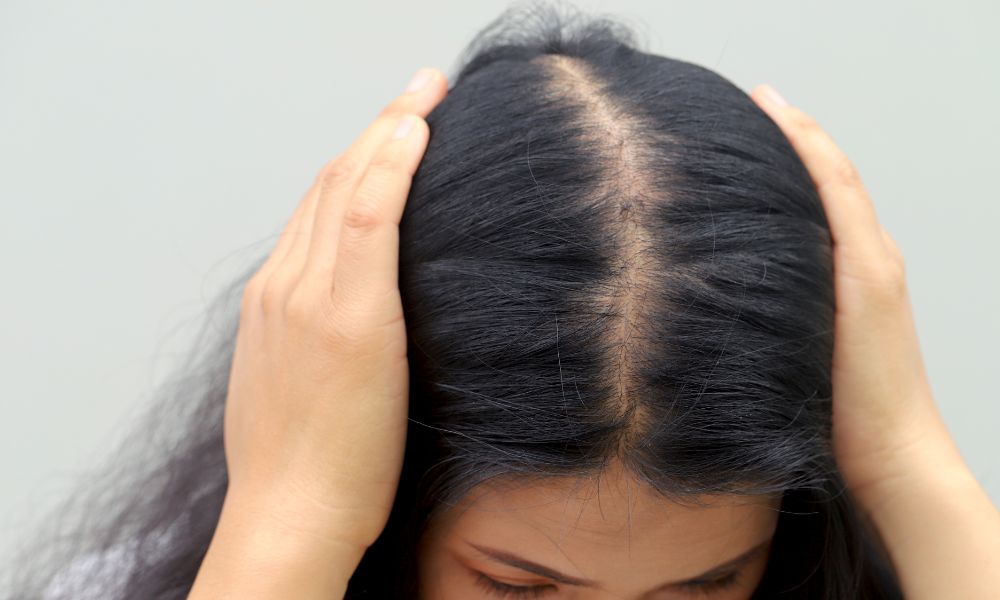 hajpótlás hajhullás után kopaszodó fejbőr